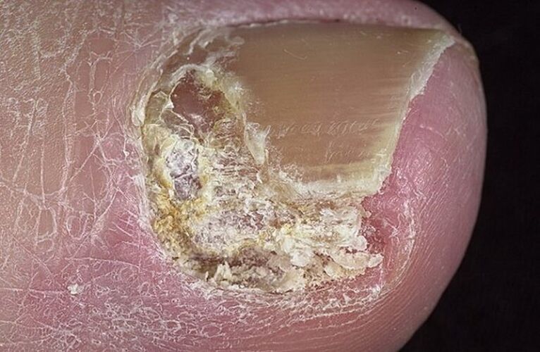 Az onychomycosis típusai